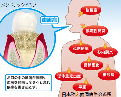 メタボリックドミノ