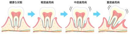 歯周病